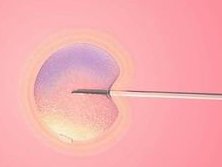 试管二代和一代分别都有哪些技术上的优缺点？