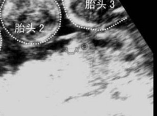 确诊为免疫性不孕能在遵义市做试管婴儿吗？做三代试管需要多少钱？